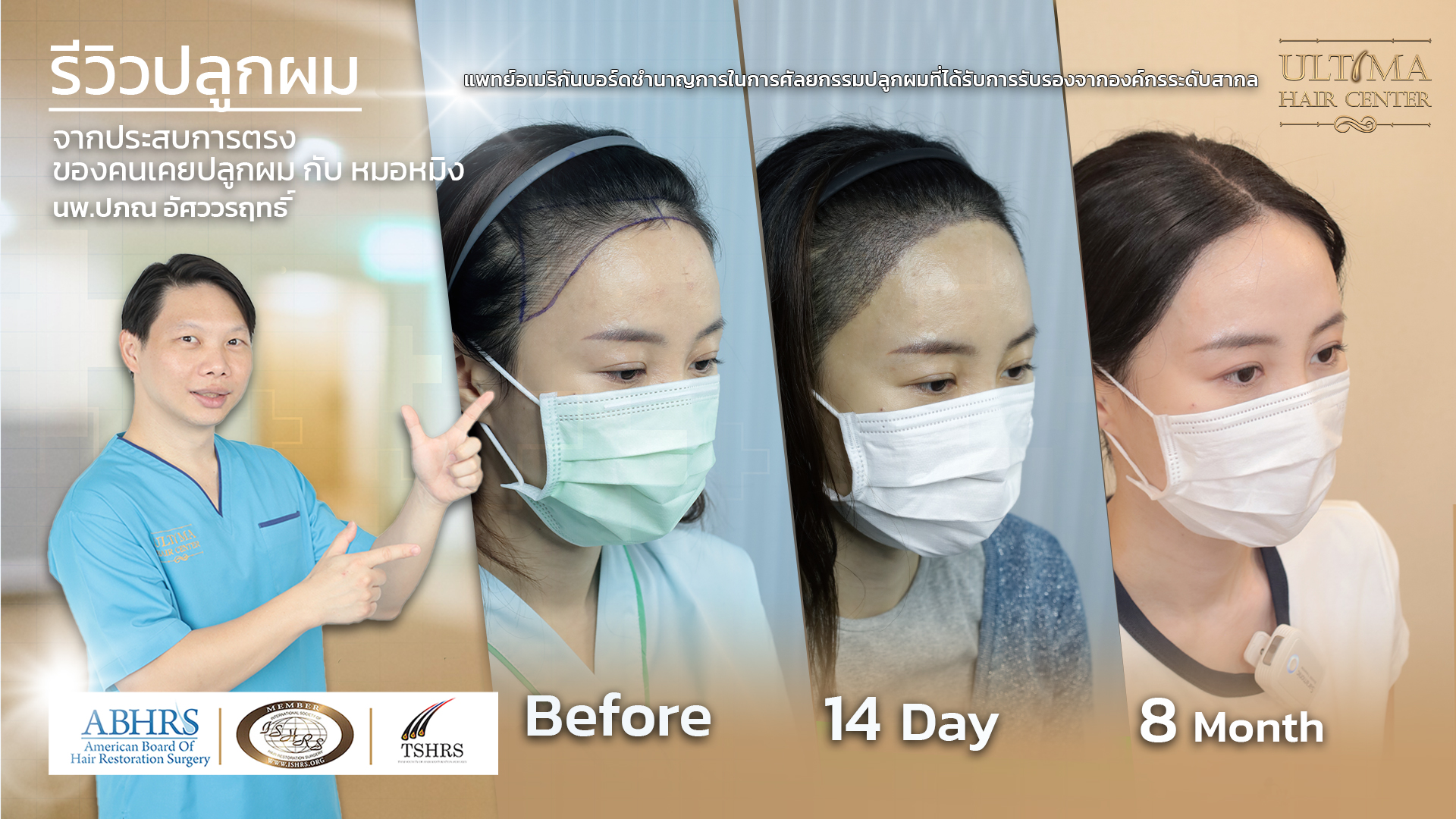 How many hair transplant sessions are possible