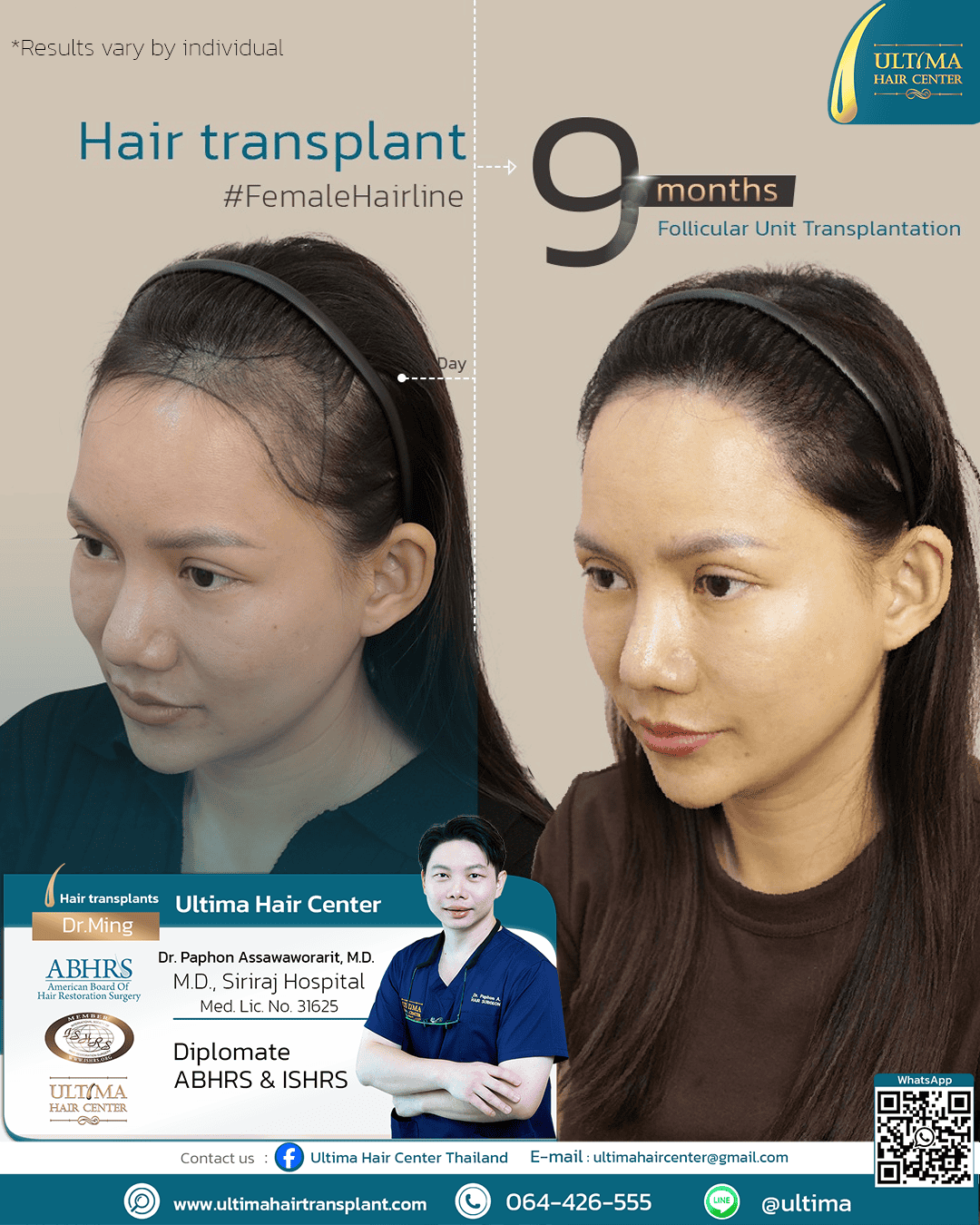 Where Can Women Have Hair Transplants