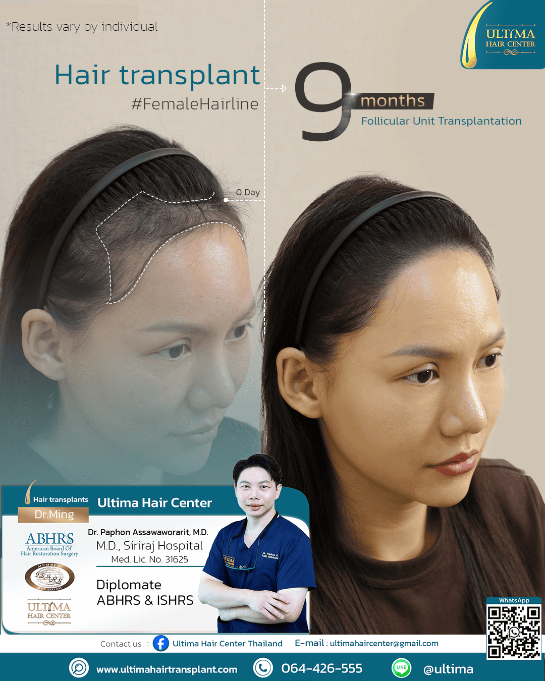Where Can Women Have Hair Transplants
