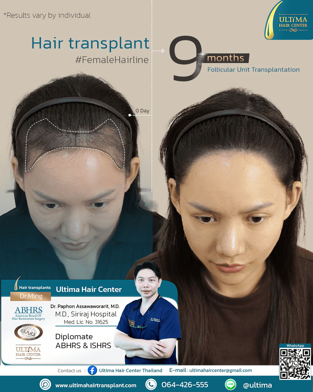 Where Can Women Have Hair Transplants