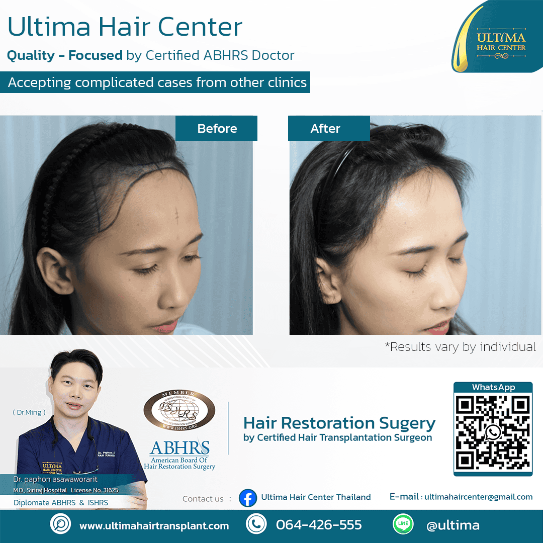 Where Can Women Have Hair Transplants