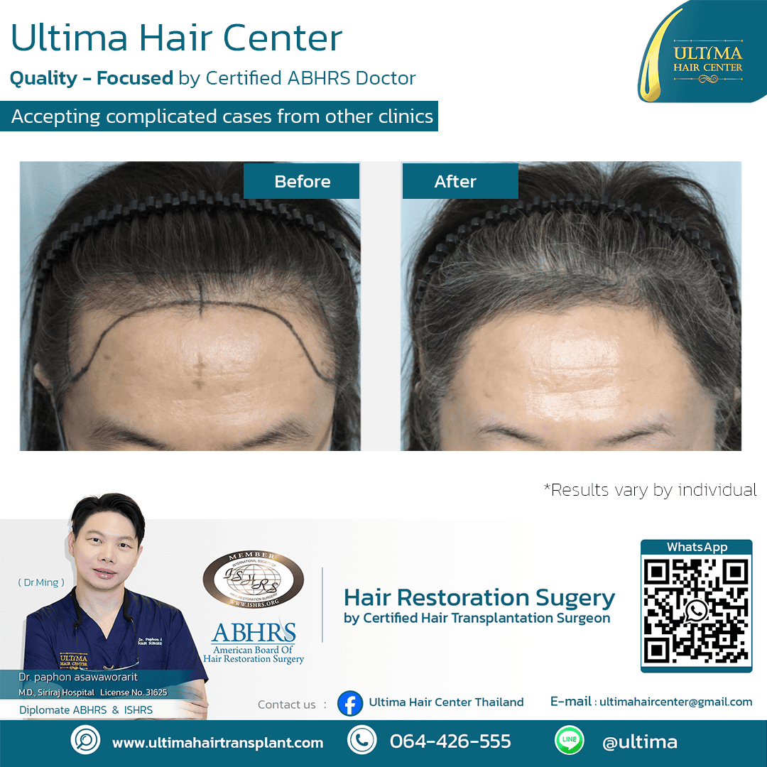 Where Can Women Have Hair Transplants