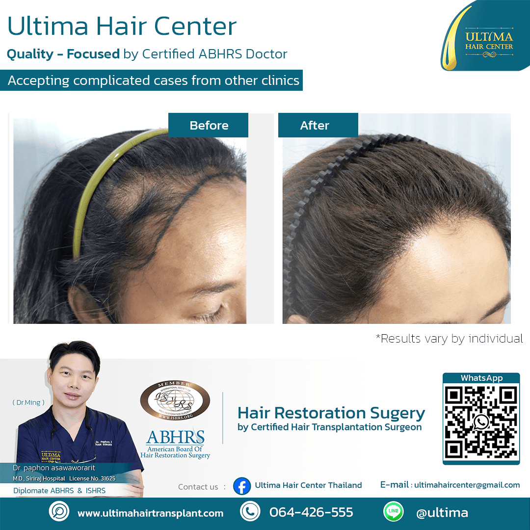 Where Can Women Have Hair Transplants