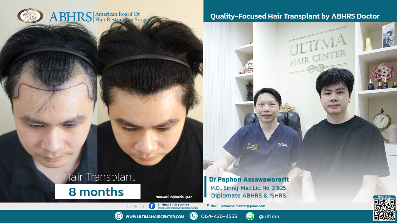 Hair Transplant at Age 30 vs. Age 60 : What Is the Difference