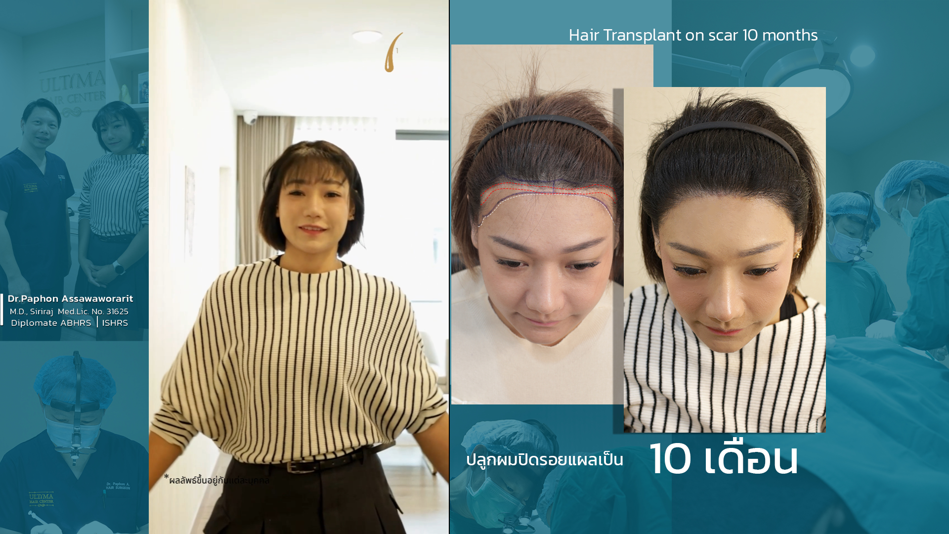 Where Can Women Have Hair Transplants