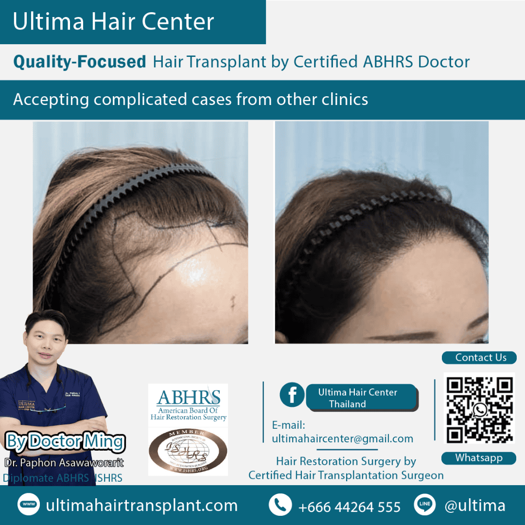 Where Can Women Have Hair Transplants
