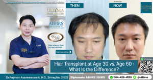 Do You Need Medication After a Hair Transplant
