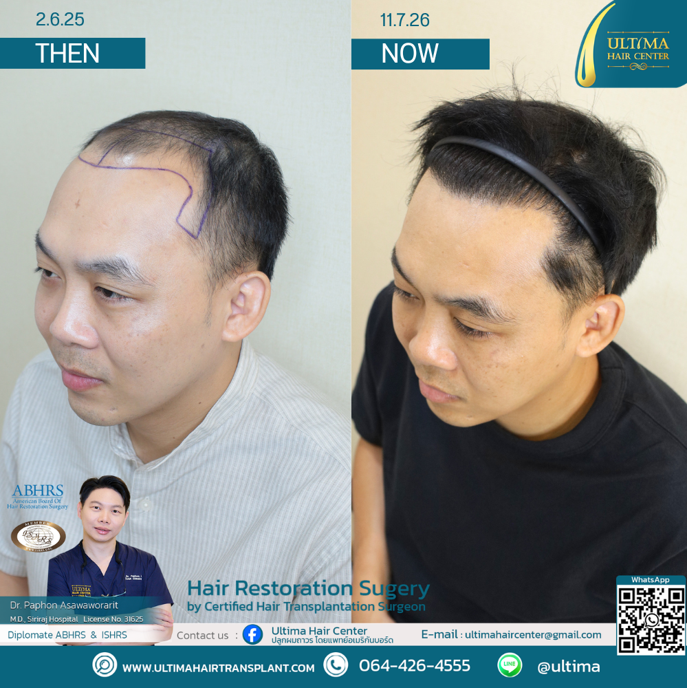 Hair Transplant at Age 30 vs. Age 60 : What Is the Difference