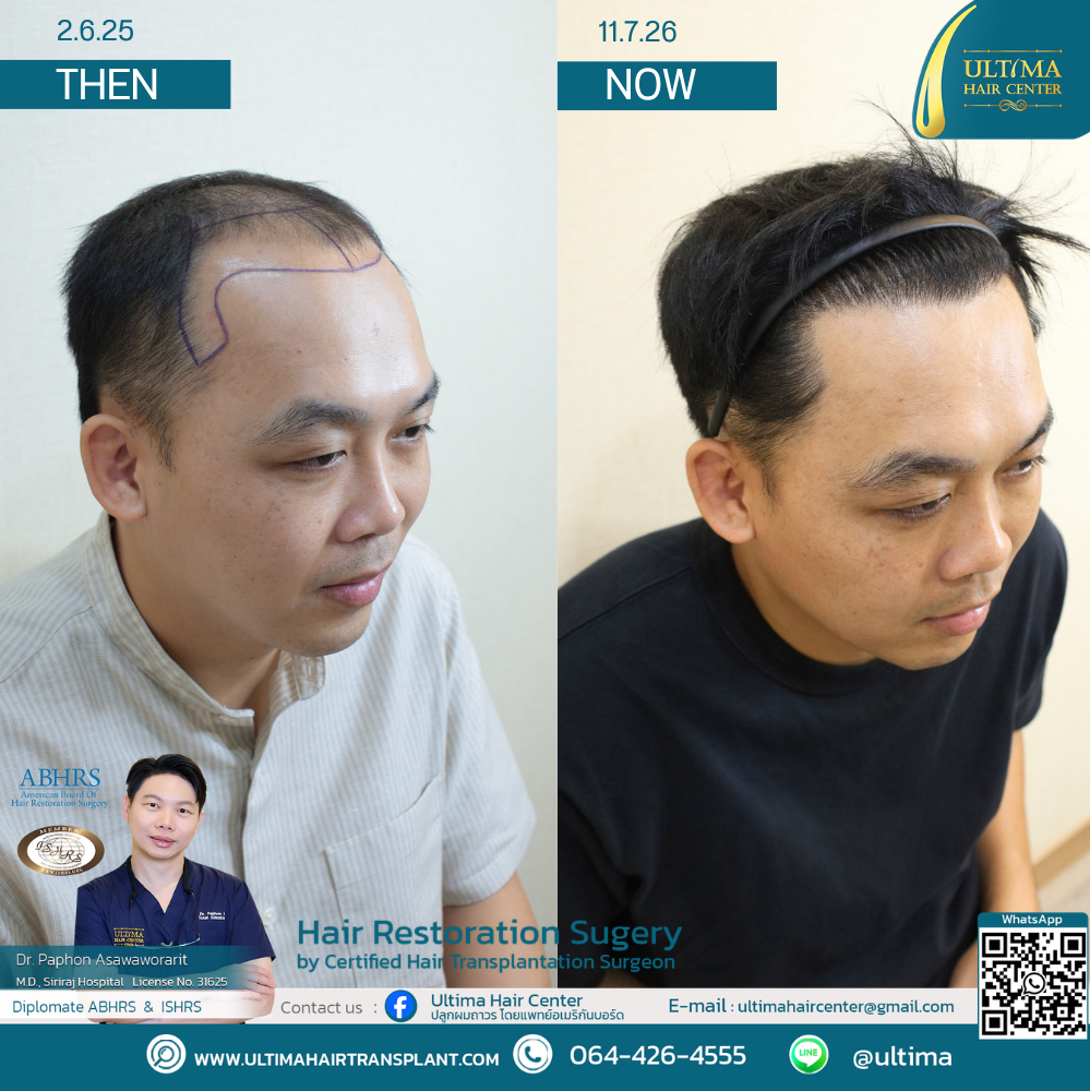 Hair Transplant at Age 30 vs. Age 60 : What Is the Difference