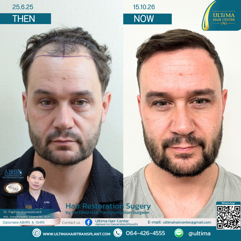 Do You Need Medication After a Hair Transplant Do You Need Medication After a Hair Transplant