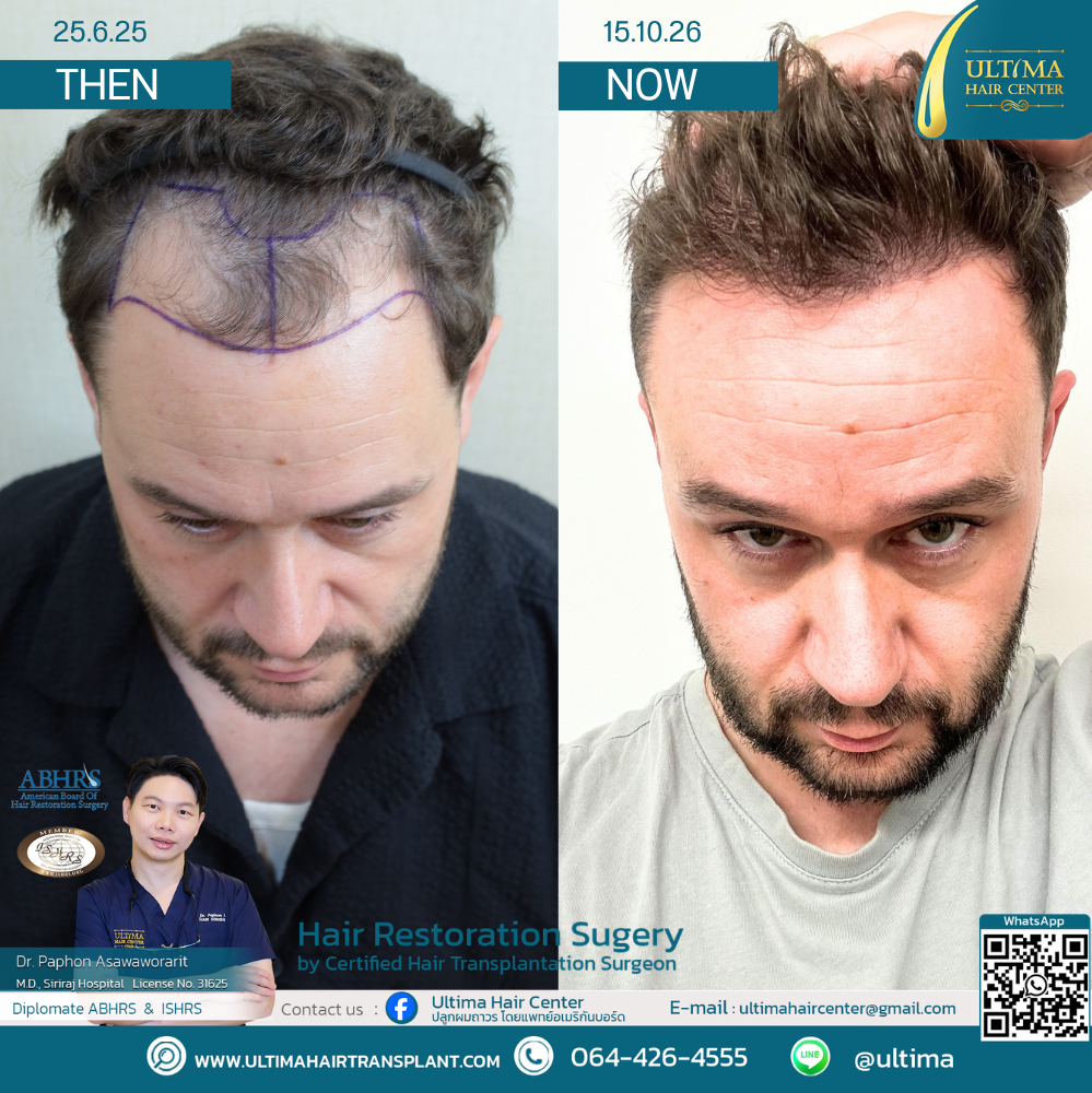 Do You Need Medication After a Hair Transplant