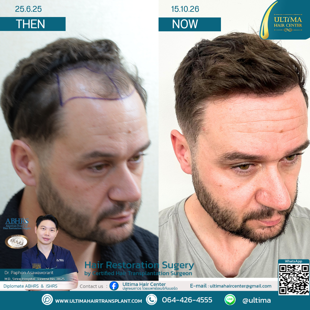 Do You Need Medication After a Hair Transplant