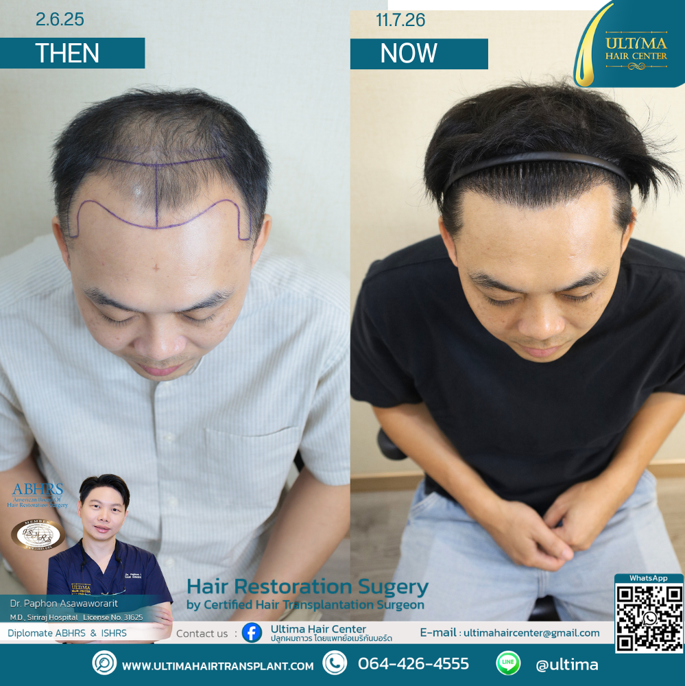 Hair Transplant at Age 30 vs. Age 60 : What Is the Difference