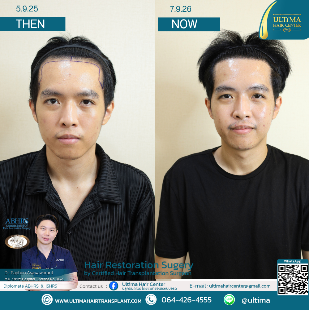 Hair Transplant at Age 30 vs. Age 60 : What Is the Difference