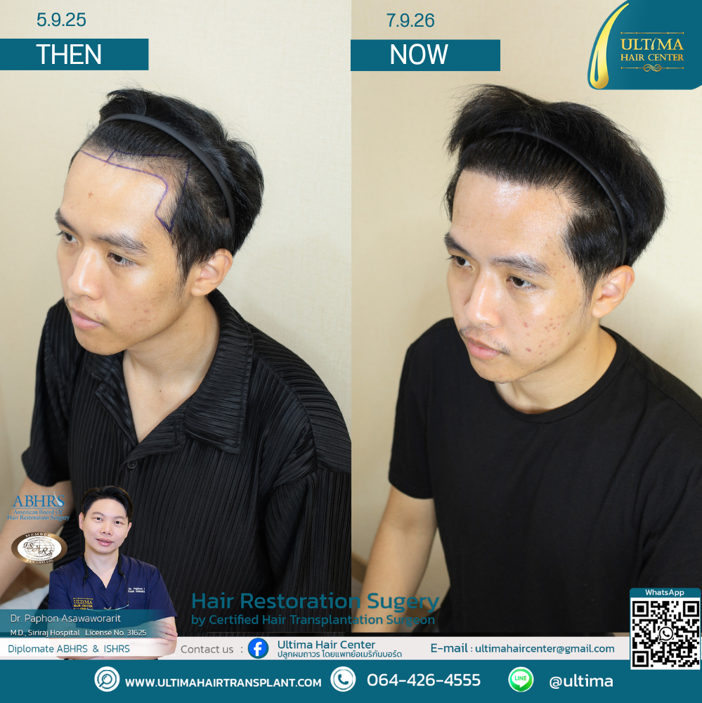 Hair Transplant at Age 30 vs. Age 60 : What Is the Difference