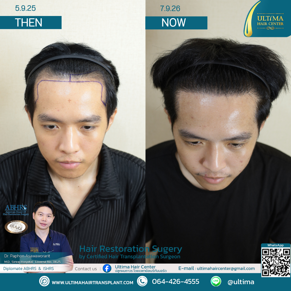 Hair Transplant at Age 30 vs. Age 60 : What Is the Difference