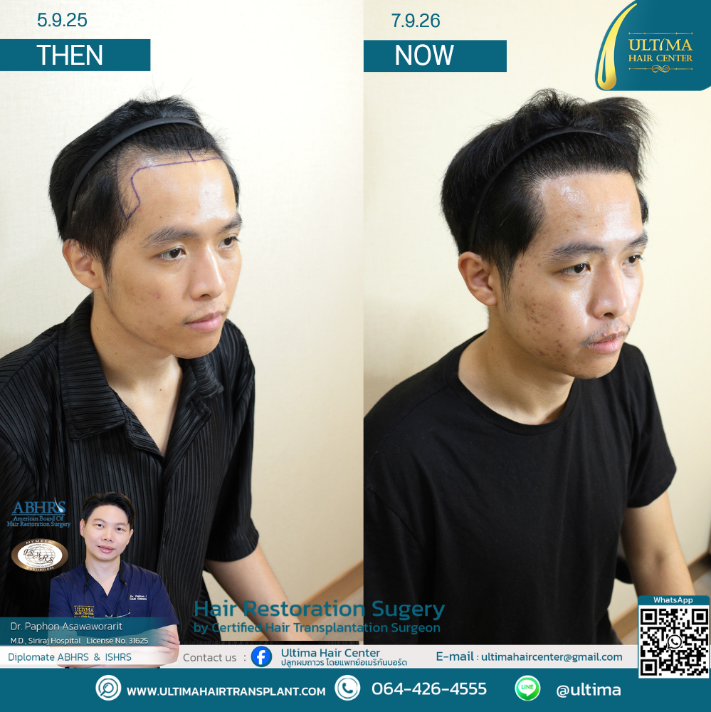 Hair Transplant at Age 30 vs. Age 60 : What Is the Difference