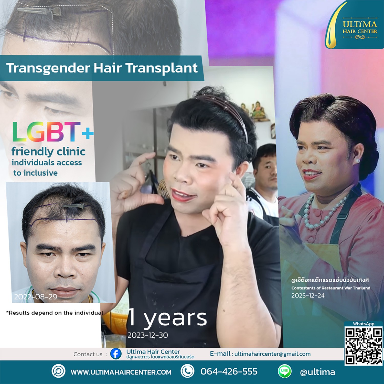 Hair Transplant at Age 30 vs. Age 60 : What Is the Difference
